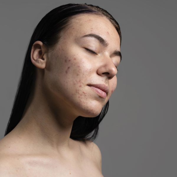 ACNE & REDNESS
